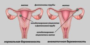 Внематочная беременность
